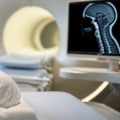 SCIWORA in Newborns: Understanding Spinal Cord Injury Without Visible Fractures, MRI Diagnosis, and Neurological Symptoms After Birth
